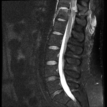 <strong> This image shows that the patient has which of the following?</strong> A) Severe dehydration of the vertebral disks B) Transected spinal cord C) Spinal cord tumor D) Cerebrospinal fluid (CSF) infection