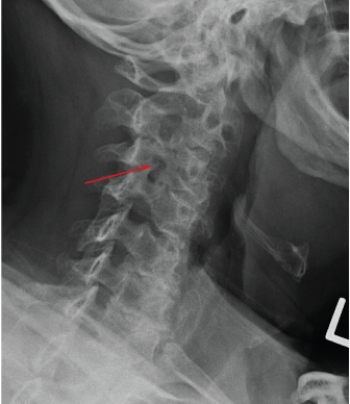 <strong> The arrow in the above image indicates:</strong> A) a pars interarticularis defect. B) a Chance fracture. C) an arthritic facet joint marginal osteophyte. D) a calcified herniated disk.