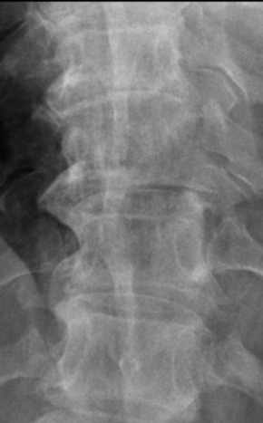 <strong> This image likely shows a patient with:</strong> A) lytic bone disease. B) scoliosis. C) vertebral body compression fracture. D) degenerative disk disease.