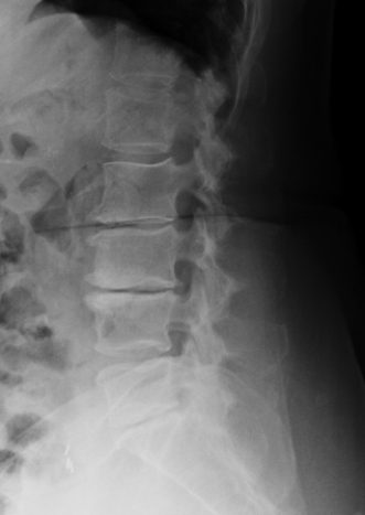 <strong> The above image depicts a patient with:</strong> A) spondylolisthesis. B) DISH. C) lytic bone disease. D) degenerative disk disease.