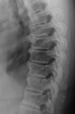 <strong> The above image depicts a patient with:</strong> A) degenerative disk disease. B) DISH. C) lytic bone disease. D) facet joint osteoarthritis.