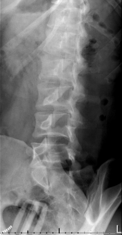 <strong> Which defect is portrayed in the image of this patient?</strong> A) An L2 pars defect B) An L3 pars defect C) An L4 pars defect D) An L5 pars defect
