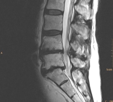 <strong> The image shows that this patient has:</strong> A) anterolisthesis of the sacrum. B) retrolisthesis of L5 in relation to the sacrum. C) bamboo spine. D) sacral fracture.