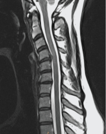 <strong> Your diagnosis based on the image shown is:</strong> A) C4/C5 disk herniation. B) dens fracture. C) metastatic disease of the spine. D) soft tissue neck injury.