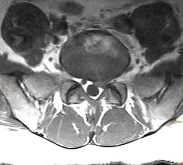 <strong> What would be your diagnosis based on the image of this patient?</strong> A) The patient has disk herniation with nerve compression. B) The patient has left L5/S1 facet joint osteoarthritis. C) The patient has bilateral L5 pedicle fractures. D) The patient has cauda equina impingement syndrome.