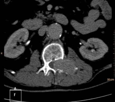 <strong> The CT shown is from a patient who presented with sciatica. Your diagnosis is most likely:</strong> A) aortic aneurysm. B) tumor in a pedicle. C) herniated disk. D) spina bifida.