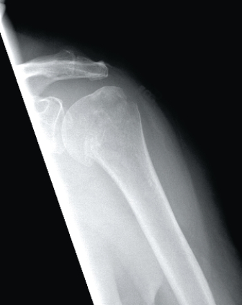 <strong> This image depicts a patient with:</strong> A) a Salter-Harris fracture. B) a normal proximal humerus. C) an anatomic neck fracture of the humerus. D) a surgical neck fracture of the humerus.