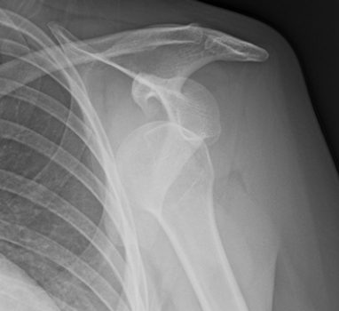 <strong> The patient depicted in the image has:</strong> A) an anterior shoulder dislocation. B) a normal shoulder in complete adduction. C) a separated shoulder. D) a fracture of the proximal humeral shaft.