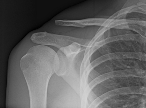 <strong> The patient in this image has:</strong> A) a dislocated shoulder. B) an AC joint separation. C) a Bankart lesion. D) a winged scapula.