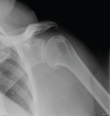 <strong> The patient in this image has:</strong> A) glenohumeral joint osteoarthritis. B) dislocated shoulder. C) separated shoulder. D) Bankart lesion.