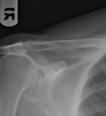 <strong> This image from a PA chest radiograph shows the incidental finding of:</strong> A) chronic AC joint separation. B) old nonunited Bankart fracture. C) a chronic full-thickness supraspinatus tear. D) blastic metastatic bone lesions.