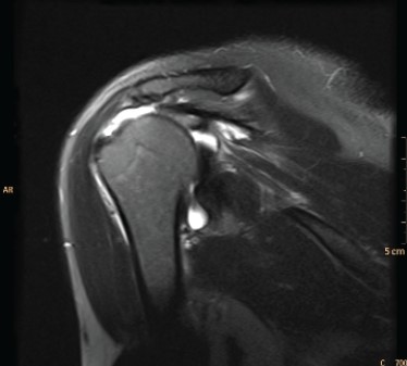 <strong> What is the diagnosis based on the coronal T2 MRI?</strong> A) AC joint separation B) Full-thickness rotator cuff tear C) Radiographically occult humeral head fracture D) Glenoid labral tear