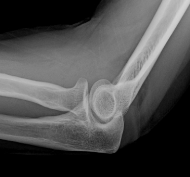 <strong> Lateral elbow radiograph after trauma; other radiographs show no fracture. Your diagnosis is:</strong> A) occult intra-articular fracture. B) dislocated elbow. C) normal elbow. D) torn distal biceps tendon tour.