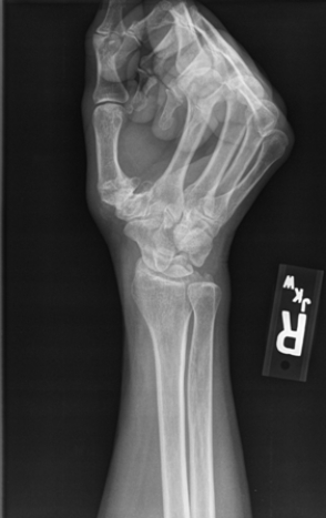 <strong> The patient in this image has:</strong> A) a boxer's fracture. B) degenerative joint disease of the first carpometacarpal joint. C) a fractured scaphoid. D) a spiral second metacarpal fracture.