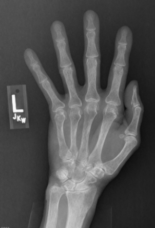 <strong> The image shows a patient with:</strong> A) acute onset of hand pain. B) a positive rheumatoid arthritis (RA) titer. C) carpal tunnel syndrome. D) history of multiple prior hand injuries.