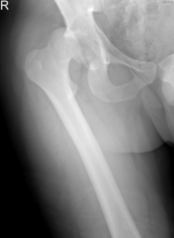 <strong> The patient in this image has:</strong> A) hip joint degenerative joint disease. B) hip joint dislocation. C) fractured femoral neck. D) femoral neck osteophyte.