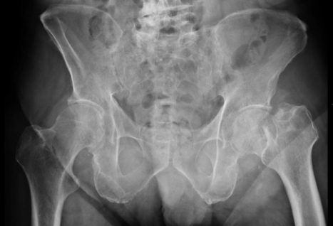 <strong> Based on the image, what condition/injury does this patient have?</strong> A) A left femoral neck fracture B) Right hip degenerative joint disease C) Lytic bone disease D) Fracture of the right ilium