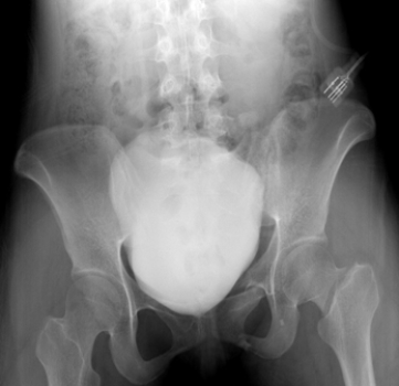 <strong> The skeletal findings in this patient with a distended bladder (opacified after contrast-enhanced CT) include:</strong> A) right hip dislocation. B) left pubic rami fractures. C) right hip joint degenerative joint disease. D) right femoral neck fracture.