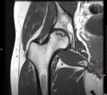 <strong> What can you tell about the patient in the MR image?</strong> A) The patient has been on high-dose steroids for a severe rash. B) The patient is an oncology patient with new onset of hip pain. C) The patient has hip pain associated with high fever and leukocytosis. D) The patient has a normal hip; symptoms in the hip are secondary to lumbar disk disease.