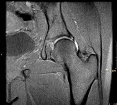 <strong> This MR arthrogram depicts a patient with:</strong> A) a normal physical exam of the hip. B) systemic arthritis. C) pain and sensation of clicking in the joint. D) injury suffered while playing shuffleboard.