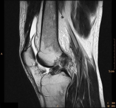 <strong> The patient in this image has:</strong> A) knee joint rheumatoid arthritis. B) a skiing injury. C) knee joint osteoarthritis. D) puncture wound to the knee joint.