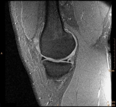 <strong> The MR image shows a patient with a:</strong> A) normal knee. B) meniscus tear. C) patella alta. D) popliteal venous thrombosis.
