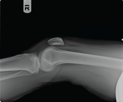 <strong> Radiographs on this patient, including the cross-table lateral shown here, revealed no visible fracture. How will the patient be managed?</strong> A) Because no fracture is shown, the patient will be told that walking is safe, NSAIDs will be prescribed, and the patient will be referred to physical therapy. B) Because of the lipohemarthrosis, the patient will be kept on non-weight-bearing and will have an urgent CT or MRI. C) Radiographic findings above suggest medial meniscus tear. The patient will be scheduled for MRI next week and will be scheduled to see an orthopedic surgeon whenever convenient. D) Physical examination was unremarkable and the patient was told to go back to work.