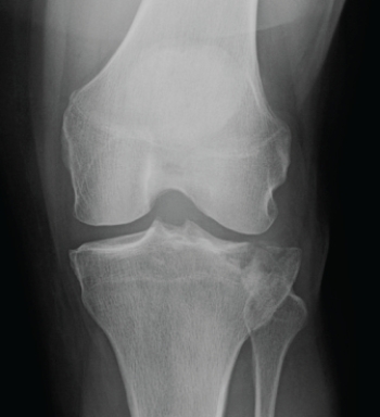 <strong> The patient in this image:</strong> A) has a normal knee. B) has a Segond fracture. C) is a patient with Osgood-Schlatter disease. D) has a tibial plateau fracture.