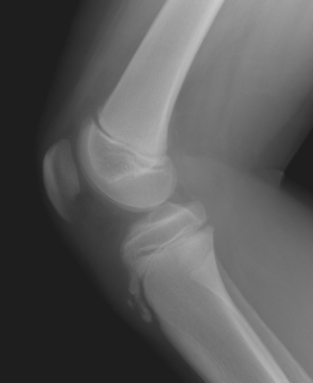 <strong> Based on the image of this pediatric patient, what can you tell this patient has?</strong> A) Clinical findings of Osgood-Schlatter disease B) Acute twisting injury of the knee C) Tenderness of the quadriceps tendon D) Popliteal fossa mass