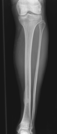 <strong> The patient in this image has which of the following injuries/conditions?</strong> A) Tibial osteosarcoma B) Lateral malleolar fracture C) A healing tibial stress fracture D) Fibula osteomyelitis