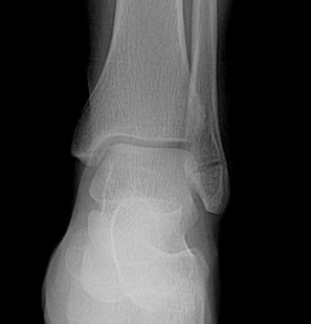 <strong> The patient in this image has suffered what type of injury?</strong> A) A lateral malleolar fracture; stable ankle mortise B) A lateral malleolar fracture with widening of the ankle mortise C) A talar dome osteochondral lesion D) Stress fracture of the first metatarsal
