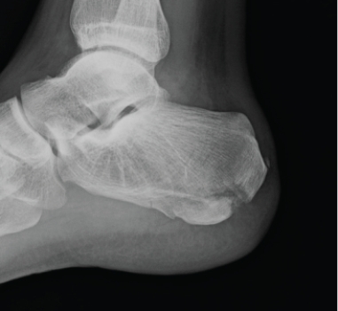 <strong> What can you tell about this patient whose lateral calcaneus radiograph is shown?</strong> A) The patient is a long-distance runner with chronic heel pain. B) The patient has lost the ability to plantar flex at the ankle. C) The patient has cancer with new onset of foot pain. D) This patient landed on his feet from a 12-foot fall and also has back pain.