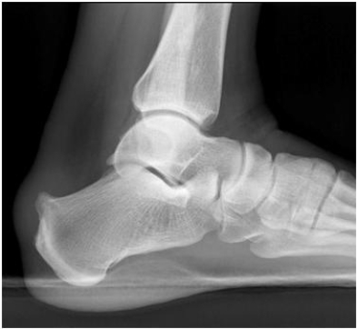 <strong> The patient in the following image has:</strong> A) a normal foot. B) a Haglund's deformity. C) a Lisfranc fracture. D) plantar fasciitis.