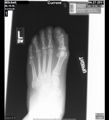 <strong> What specific injury/deformity does the patient in this image suffer from?</strong> A) Rheumatoid arthritis (RA) of the first tarso-metatarsal joint B) Lisfranc fracture C) Bunion deformity D) Haglund's deformity