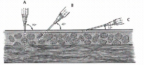 <strong>Using the illustration below, select the proper angle for the nurse to use in administering a subcutaneous injection for the average adult.  </strong> A) 90° B) 45° C) 15° D) Any of the above <div style=padding-top: 35px> 