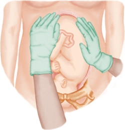 <strong>The nurse is performing Leopold's maneuvers on a client. Which figure depicts the Leopold's maneuver that determines whether the fetal presenting part is engaged in the maternal pelvis. Refer to Figures a to d</strong> A) B) C) D)