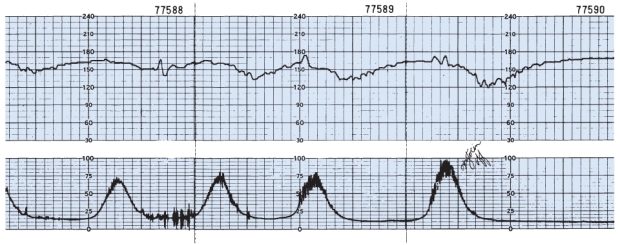 <strong>Client is at 38 weeks' gestation, gravida 1, para 0, vaginal exam-4 cm, 100% effaced, +1 station vertex. What is the most likely intervention for this fetal heart rate pattern? </strong> A) Continue oxytocin (Pitocin) infusion. B) Contact the anesthesia department for epidural administration. C) Change maternal position. D) Administer Narcan to client and prepare for immediate vaginal delivery.