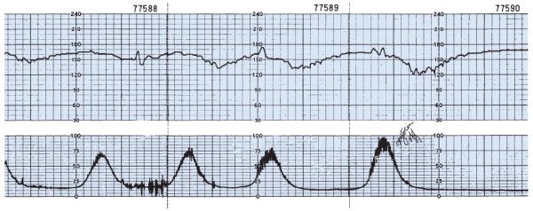 The nurse is monitoring a client in labor and notes this fetal heart rate pattern on the electronic fetal monitoring strip (see figure). Which is the most appropriate nursing action?
