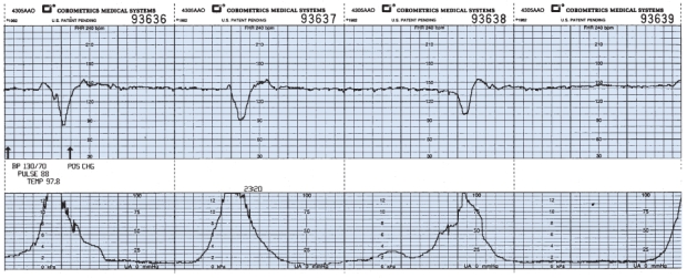 The nurse is monitoring a client in labor and notes this fetal heart rate pattern on the electronic fetal monitoring strip (see figure). Which is the most appropriate nursing action?