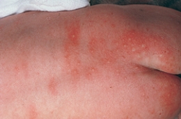 <strong>The nurse is assessing a newborn and notes a nevus flammeus birthmark. Which of the following figures depicts this birthmark? </strong> A) B) C) D)