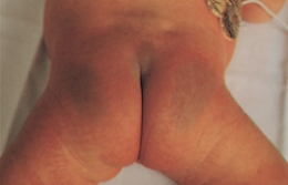 <strong>The nurse is assessing a newborn and notes a nevus flammeus birthmark. Which of the following figures depicts this birthmark? </strong> A) B) C) D)