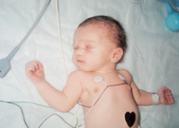 <strong>The nurse is assessing a newborn and notes a nevus flammeus birthmark. Which of the following figures depicts this birthmark? </strong> A) B) C) D)