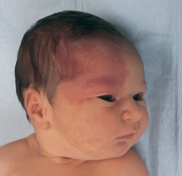 <strong>The nurse is assessing a newborn and notes a nevus flammeus birthmark. Which of the following figures depicts this birthmark? </strong> A) B) C) D)