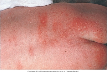 <strong>The nurse is assessing a newborn and notes a nevus flammeus birthmark. Which of the following figures depicts this birthmark?</strong> A) B) C) D)