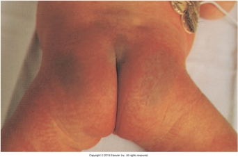 <strong>The nurse is assessing a newborn and notes a nevus flammeus birthmark. Which of the following figures depicts this birthmark?</strong> A) B) C) D)