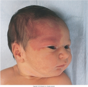 <strong>The nurse is assessing a newborn and notes a nevus flammeus birthmark. Which of the following figures depicts this birthmark?</strong> A) B) C) D)