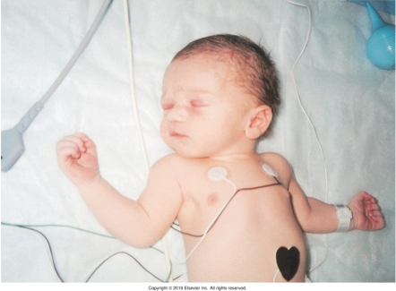 <strong>The nurse is assessing a newborn and notes a nevus flammeus birthmark. Which of the following figures depicts this birthmark?</strong> A) B) C) D)