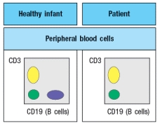 An infant is admitted to the hospital with a history of recurrent and persistent bacterial infections. His physician suspects he has an immunodeficiency disease, and obtains a sample of the patient's peripheral blood. The white blood cells are analyzed by antibody staining followed by flow cytometry, and the results are shown in Figure. To determine the origin of the peripheral blood cell defect, a bone marrow biopsy is taken from the patient and compared to a healthy control, as shown in Figure. To obtain additional information, bone marrow cells are treated with a chemical that permeabilizes the cell membrane, allowing antibodies to enter the cells and bind to their target antigens within the cells, a technique known as ‘intracellular staining’. The results of this analysis are shown in Figure . a) What are populations 1, 2, and 3 in Figure? b) In the analysis of cell surface expression (non-permeabilized bone marrow cells), what are the IgM<sup>lo</sup> Igκ<sup>+</sup>λ<sup>neg</sup> cells as indicated by the arrow in Figure? c) What is the most likely defect causing the patient's immunodeficiency? The results shown above indicate a specific defect in B cell development. To help identify the defective or missing protein in the patient's developing B cells, bone marrow cells are isolated and protein lysates are prepared for immunoblotting. A series of antibodies are tested and the results are shown in Figure. d) Given the results from the immunoblotting experiments, what is the most likely candidate molecule (or type of molecule) responsible for the patient's immunodeficiency disease?