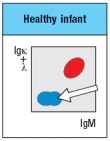 An infant is admitted to the hospital with a history of recurrent and persistent bacterial infections. His physician suspects he has an immunodeficiency disease, and obtains a sample of the patient's peripheral blood. The white blood cells are analyzed by antibody staining followed by flow cytometry, and the results are shown in Figure. To determine the origin of the peripheral blood cell defect, a bone marrow biopsy is taken from the patient and compared to a healthy control, as shown in Figure. To obtain additional information, bone marrow cells are treated with a chemical that permeabilizes the cell membrane, allowing antibodies to enter the cells and bind to their target antigens within the cells, a technique known as ‘intracellular staining’. The results of this analysis are shown in Figure . a) What are populations 1, 2, and 3 in Figure? b) In the analysis of cell surface expression (non-permeabilized bone marrow cells), what are the IgM<sup>lo</sup> Igκ<sup>+</sup>λ<sup>neg</sup> cells as indicated by the arrow in Figure? c) What is the most likely defect causing the patient's immunodeficiency? The results shown above indicate a specific defect in B cell development. To help identify the defective or missing protein in the patient's developing B cells, bone marrow cells are isolated and protein lysates are prepared for immunoblotting. A series of antibodies are tested and the results are shown in Figure. d) Given the results from the immunoblotting experiments, what is the most likely candidate molecule (or type of molecule) responsible for the patient's immunodeficiency disease?