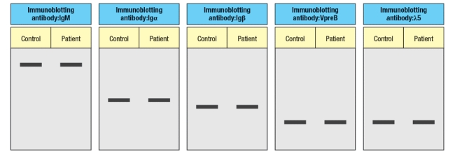 An infant is admitted to the hospital with a history of recurrent and persistent bacterial infections. His physician suspects he has an immunodeficiency disease, and obtains a sample of the patient's peripheral blood. The white blood cells are analyzed by antibody staining followed by flow cytometry, and the results are shown in Figure. To determine the origin of the peripheral blood cell defect, a bone marrow biopsy is taken from the patient and compared to a healthy control, as shown in Figure. To obtain additional information, bone marrow cells are treated with a chemical that permeabilizes the cell membrane, allowing antibodies to enter the cells and bind to their target antigens within the cells, a technique known as ‘intracellular staining’. The results of this analysis are shown in Figure . a) What are populations 1, 2, and 3 in Figure? b) In the analysis of cell surface expression (non-permeabilized bone marrow cells), what are the IgM<sup>lo</sup> Igκ<sup>+</sup>λ<sup>neg</sup> cells as indicated by the arrow in Figure? c) What is the most likely defect causing the patient's immunodeficiency? The results shown above indicate a specific defect in B cell development. To help identify the defective or missing protein in the patient's developing B cells, bone marrow cells are isolated and protein lysates are prepared for immunoblotting. A series of antibodies are tested and the results are shown in Figure. d) Given the results from the immunoblotting experiments, what is the most likely candidate molecule (or type of molecule) responsible for the patient's immunodeficiency disease?